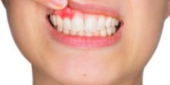 التهاب الأسنان: أسبابه، أعراضه، وطرق علاجه