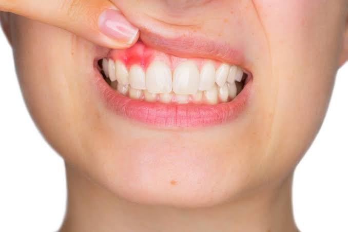التهاب الأسنان: أسبابه، أعراضه، وطرق علاجه